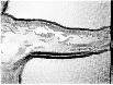 braquiplastia2