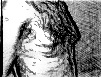 ginecomastia2