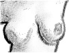 mastoplastia2