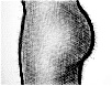 proteses-de-gluteo2